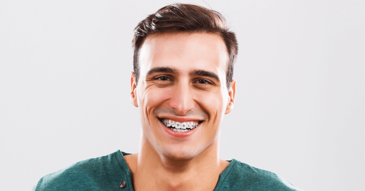 Can Black Triangles Between Teeth Be Fixed with Braces?
